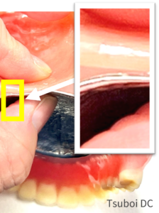 保険義歯と金属床義歯の厚みを比較した画像