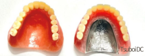 保険総義歯と金属床義歯の画像
