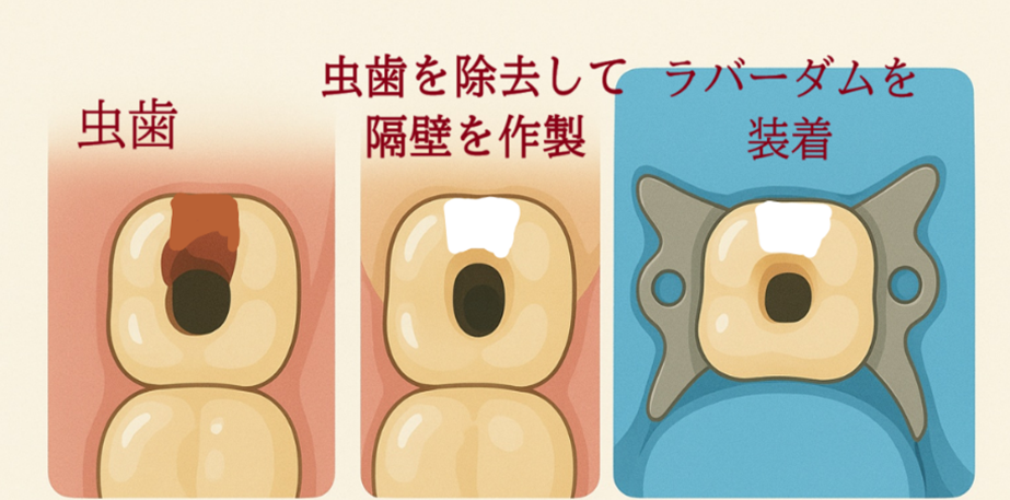 岩国市 歯医者 ラバーダム