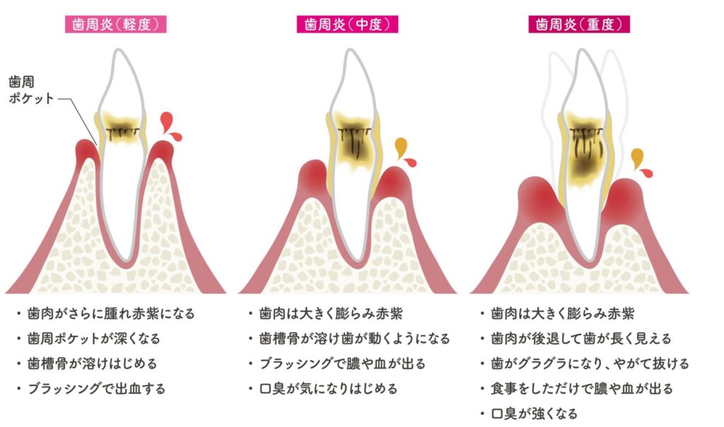 岩国市　歯医者　歯周病