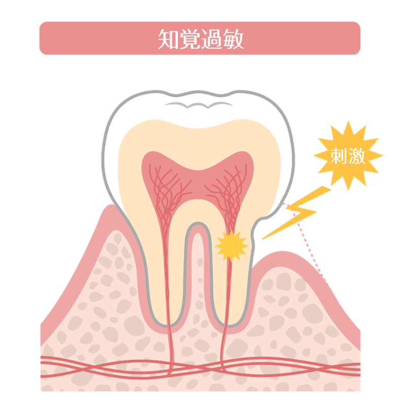 岩国市 歯科 知覚過敏