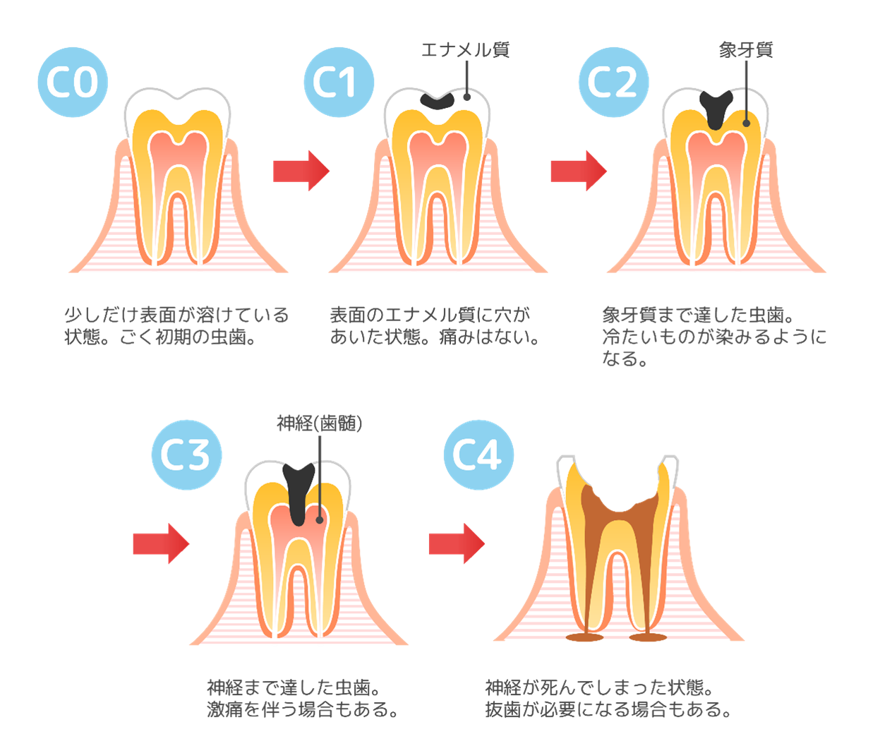 岩国市 歯科 根治