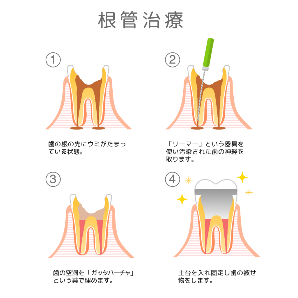 岩国市 歯科 精密根管治療