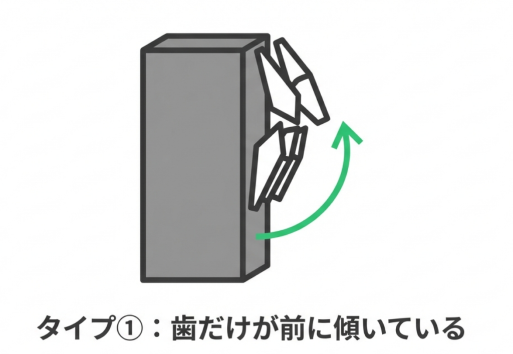 岩国市 矯正 出っ歯