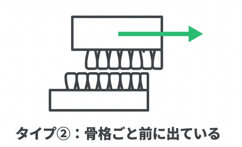 岩国市 矯正 出っ歯