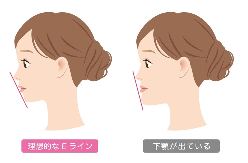 岩国市　矯正　受け口