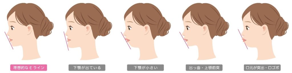 岩国市 矯正 出っ歯