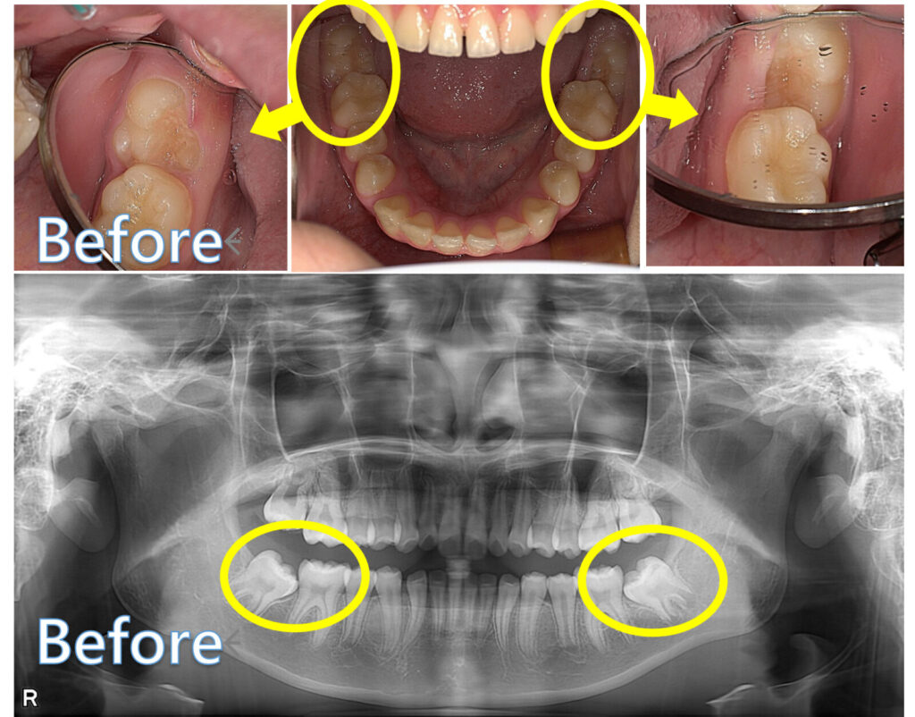 岩国市　小児歯科　矯正