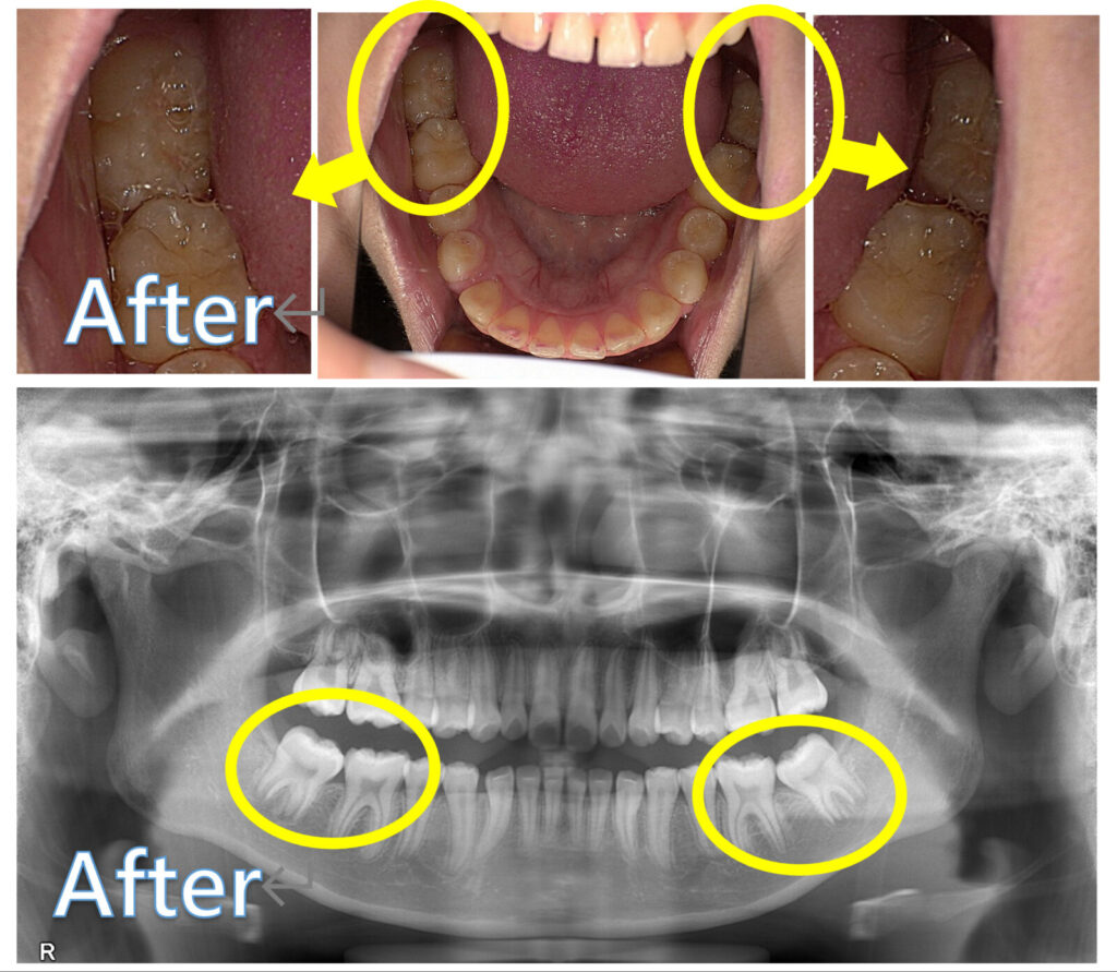 岩国市　小児歯科　矯正