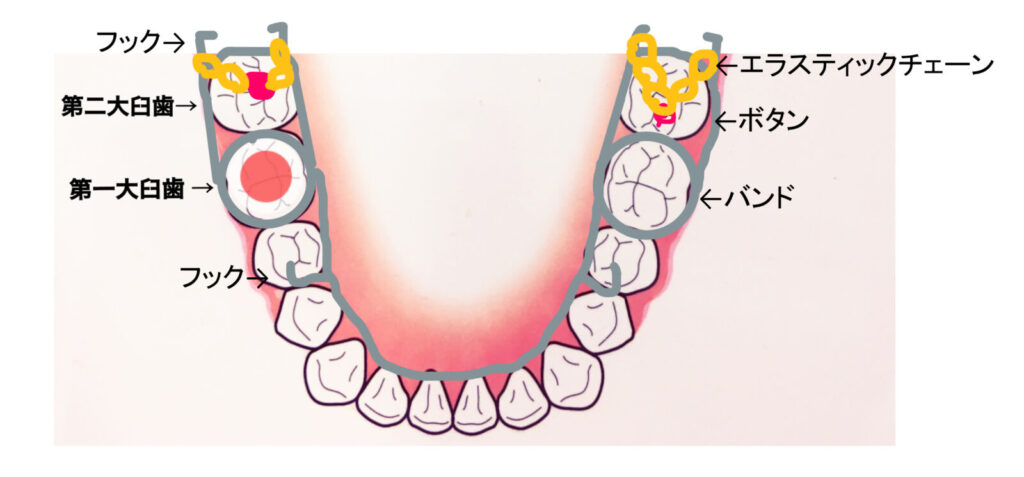 岩国市　小児歯科　矯正