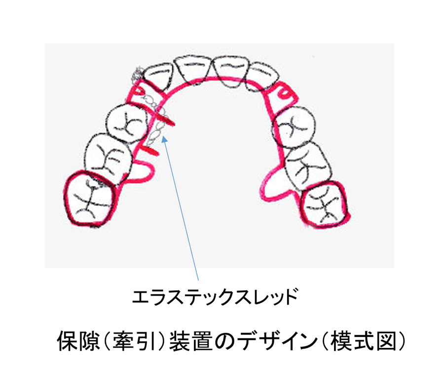 岩国市 こども 部分矯正