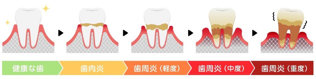 岩国市 歯周病 骨再生療法