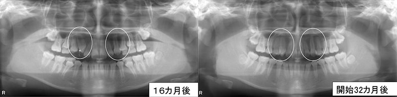 抜歯後のレントゲン