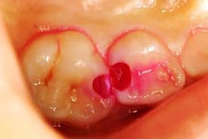 「う蝕検知液」で虫歯感染部分がわかる