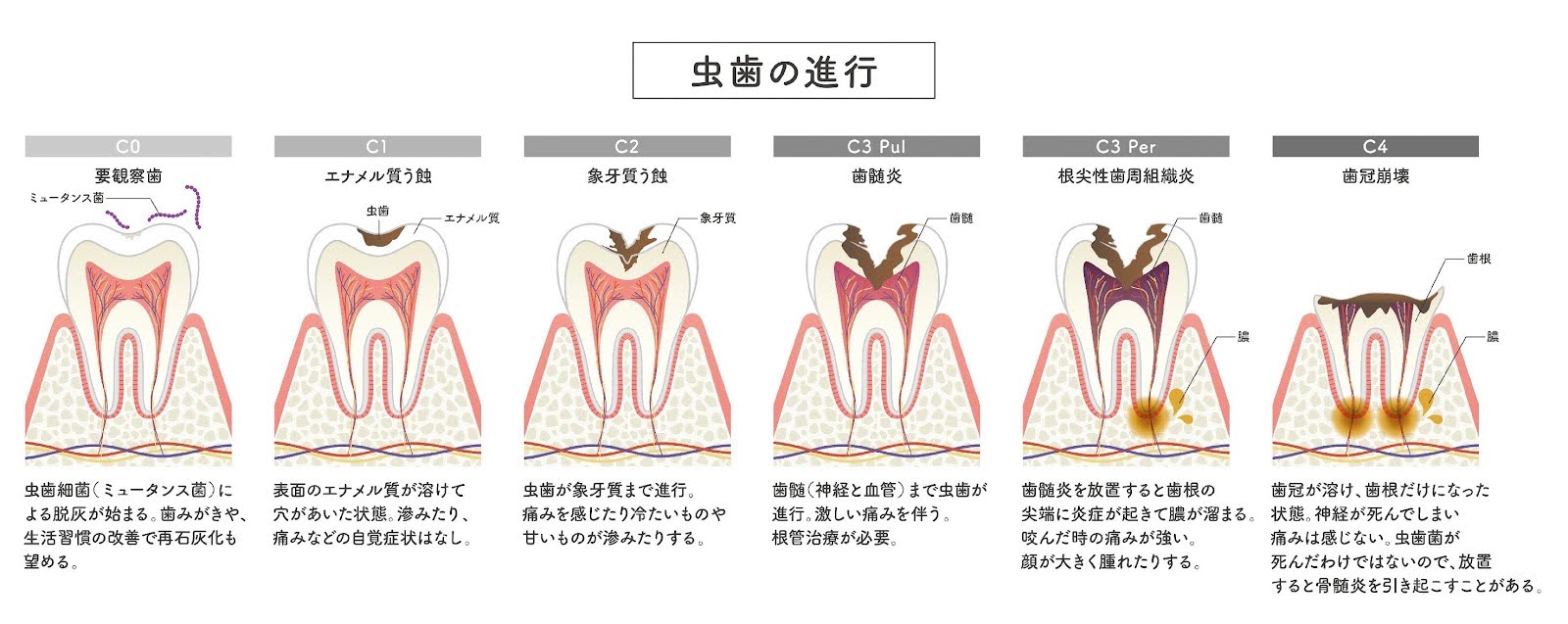 奥歯の溝が黒いのですが、これは虫歯ですか？