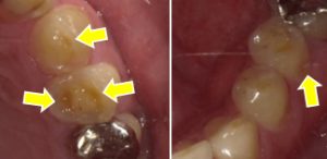 酸触症により象牙質が露出して色合いが暗く、歯もへこんでいる図
