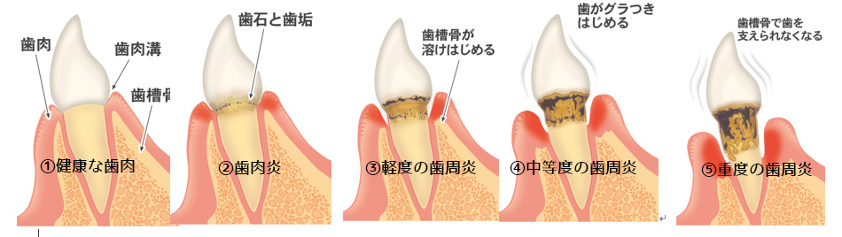 健康な歯肉から歯肉炎・歯周病へ悪化していく状況を説明した図
